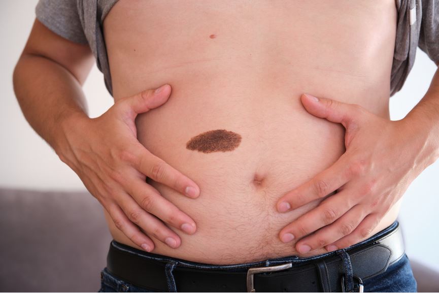 生まれつき あざ 前世